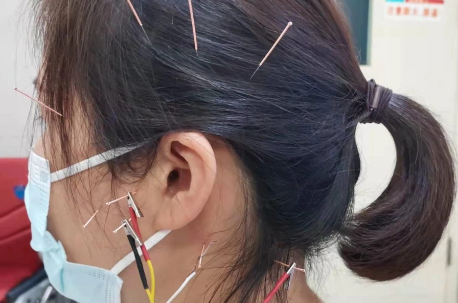 耳鳴針灸治療