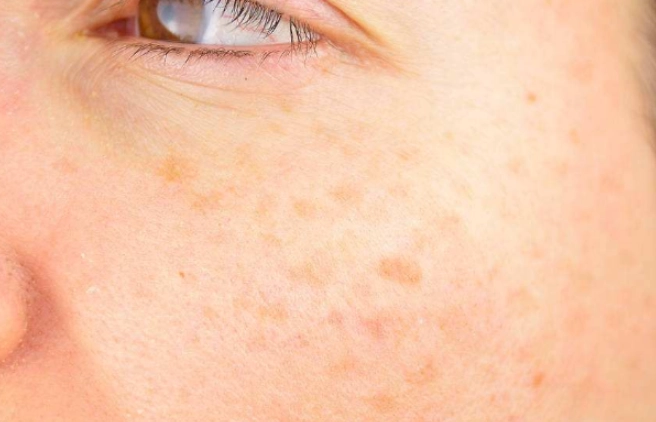 肝斑預防 肝斑預防