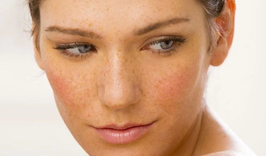 色素沉澱治療 色素沉澱治療