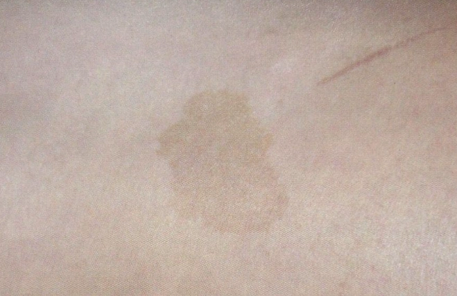 咖啡色斑塊治療 咖啡色斑塊治療
