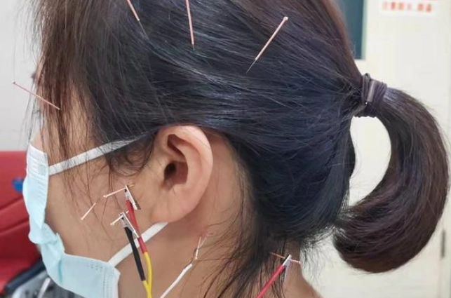 耳鳴針灸治療