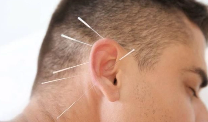 耳鳴針灸治療