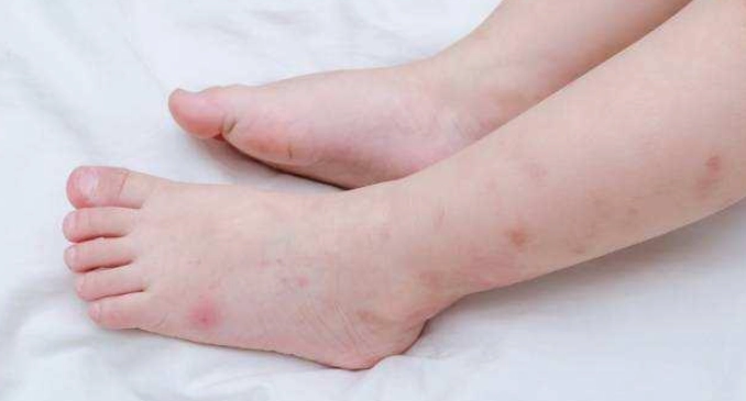 兒童蚊蟲叮咬處理