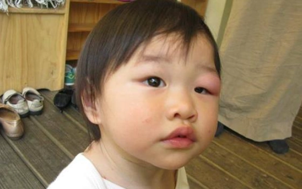 嬰兒眼皮蚊蟲叮咬