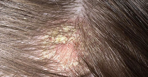 頭皮結痂原因