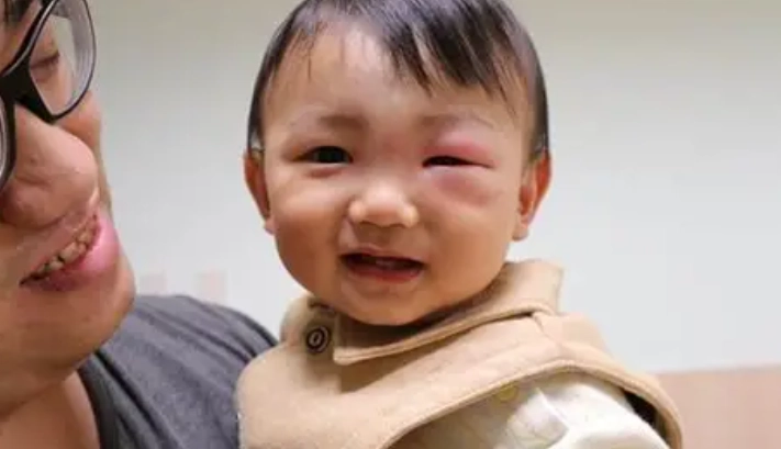 被蚊子叮眼睛消腫