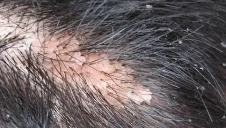 頭皮粉紅色治療