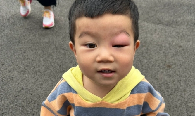 幼兒眼睛被蚊子叮處理