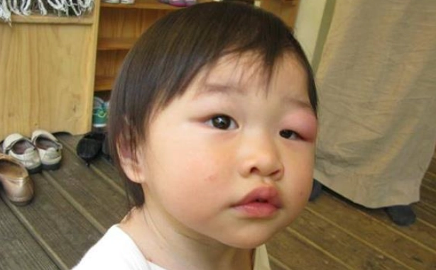 被蚊子叮眼睛消腫