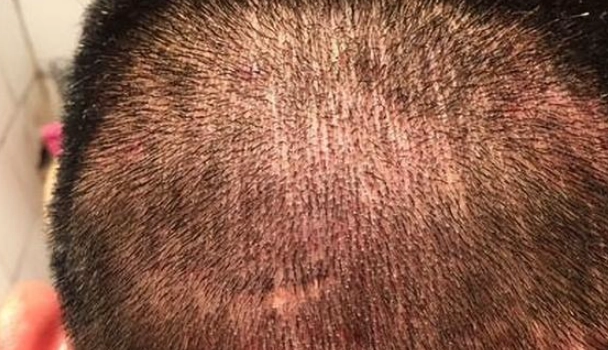 頭皮粉紅色原因