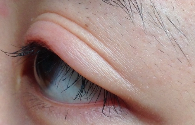 蚊子叮眼皮腫脹