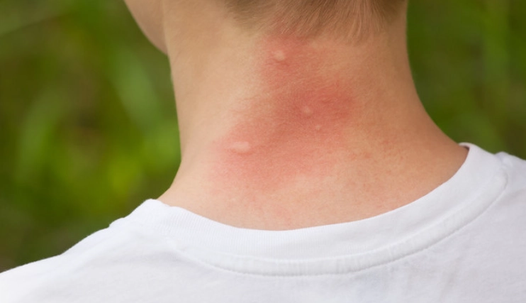 蚊子叮咬血型關係