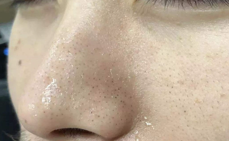 黑头粉刺去除方法 黑头粉刺去除方法