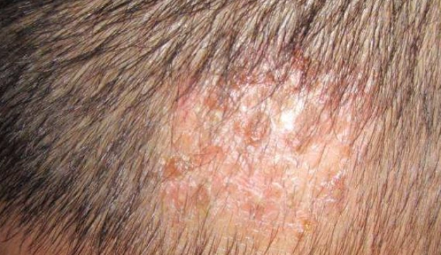 頭皮紅紅的不癢原因
