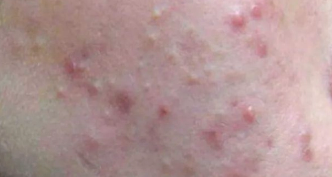 粉刺自己會好嗎