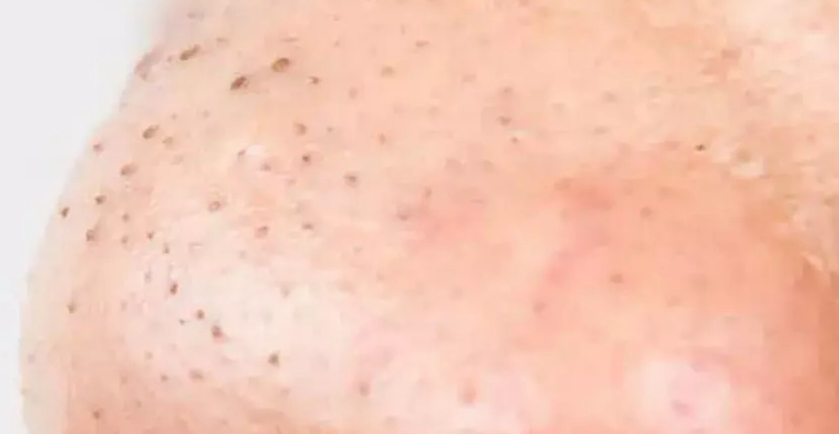 去黑头方法 去黑头方法