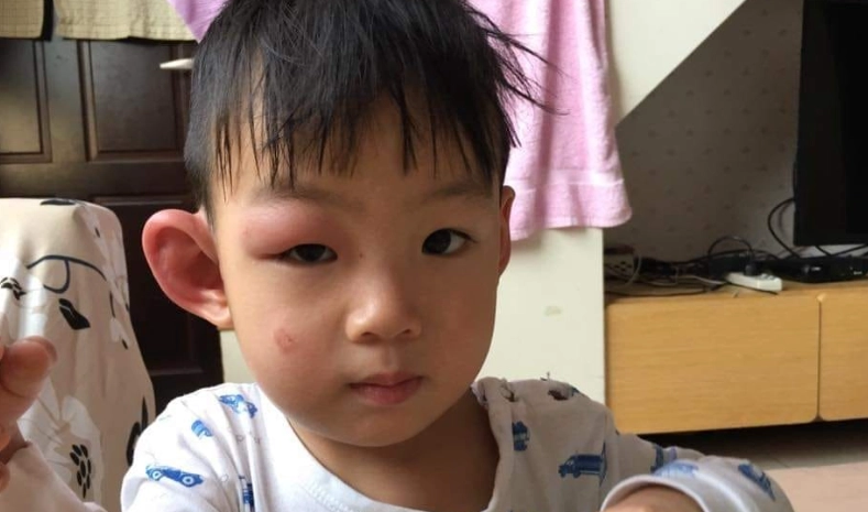 蚊子叮咬消肿方法