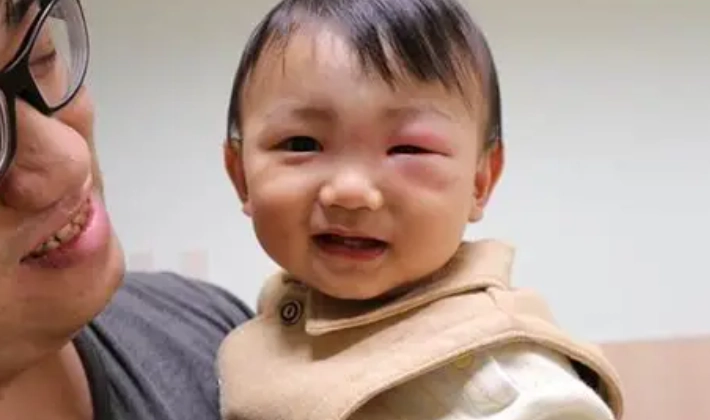 嬰兒眼皮蚊蟲叮咬