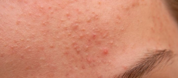 閉鎖性粉刺清除