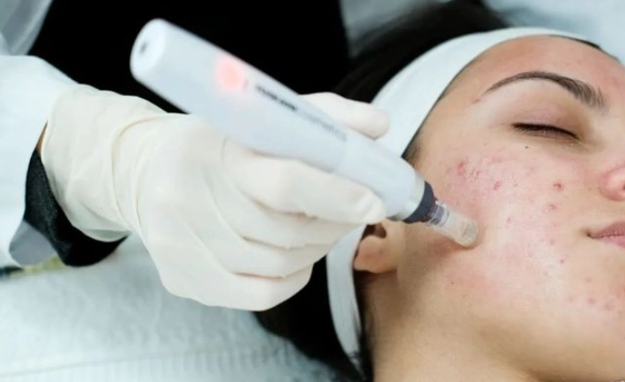 黑頭粉刺清潔 黑頭粉刺清潔