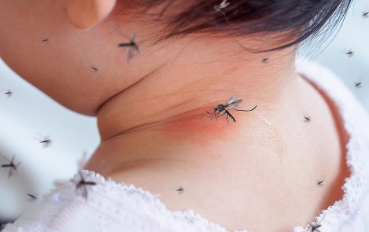 蚊子叮咬消肿方法