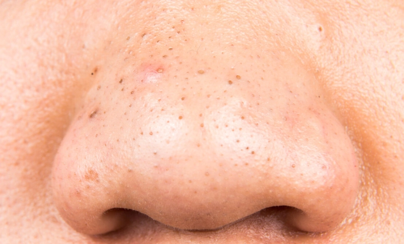 鼻子黑頭去除方法 鼻子黑頭去除方法