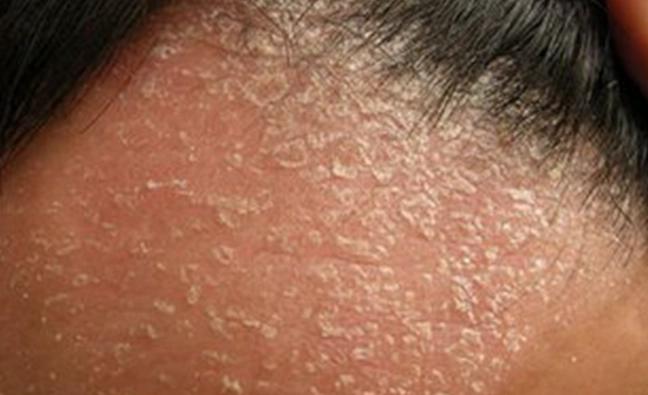 頭皮紅紅的不癢原因