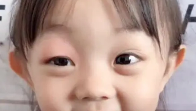 嬰兒眼皮蚊蟲叮咬