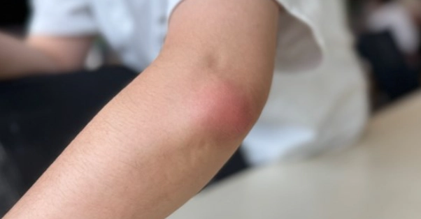 蚊子叮咬痒原因 蚊子叮咬痒原因