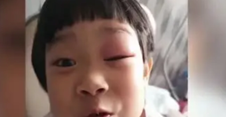 嬰兒眼睛叮咬腫脹