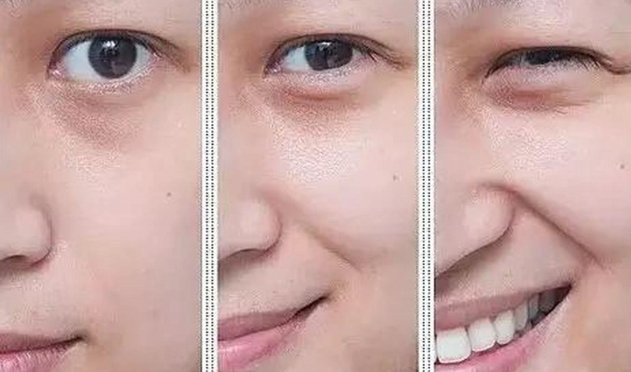 法令紋保養 法令紋保養