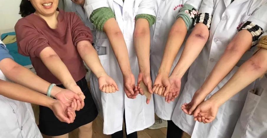 手臂刮痧技巧 手臂刮痧技巧