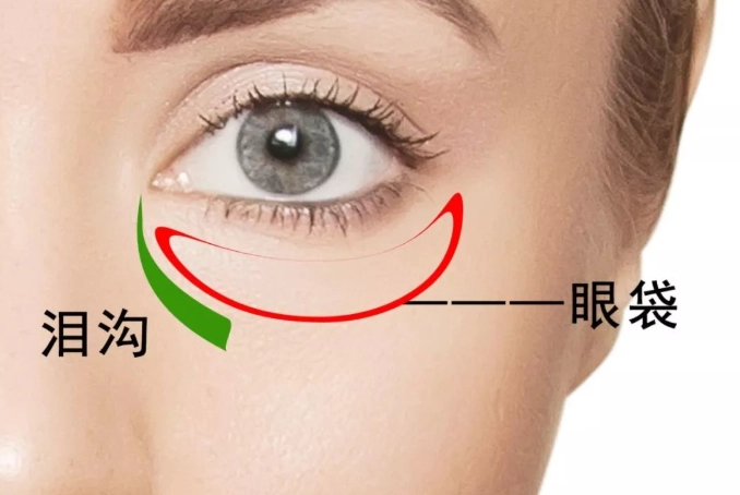 眼下凹陷成因
