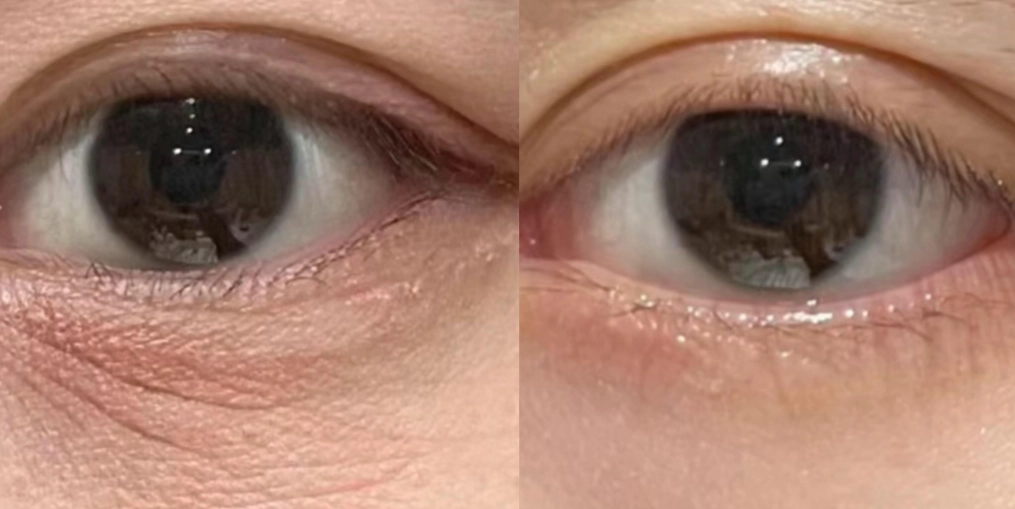 法令紋保養 法令紋保養