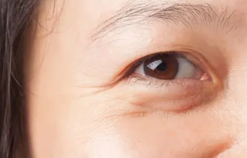 眼袋改善方法