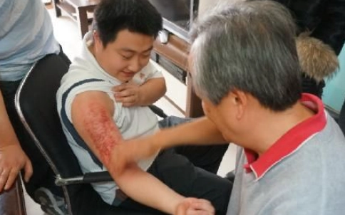 手臂刮痧技巧 手臂刮痧技巧