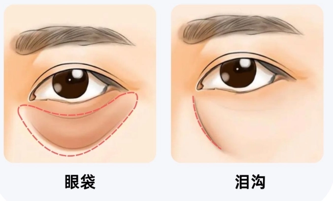 眼下凹陷成因