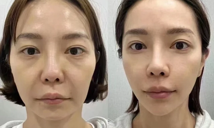 法令紋保養 法令紋保養