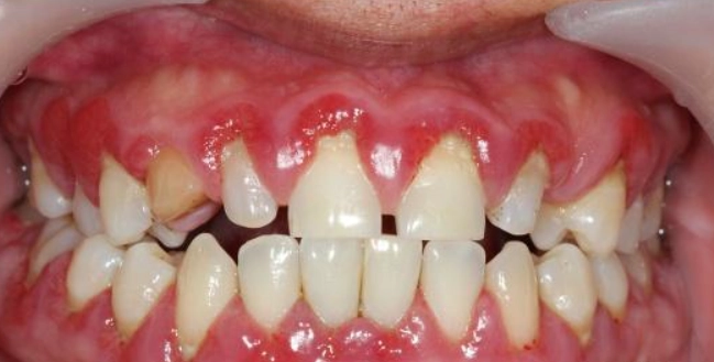 牙齦萎縮怎麼辦