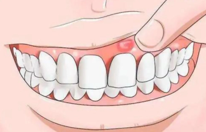 牙齦腫消腫方法