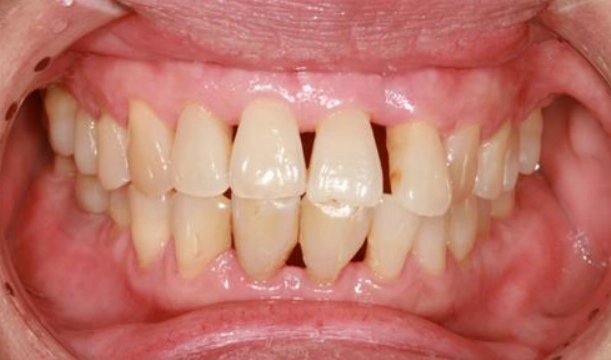 牙齦萎縮原因
