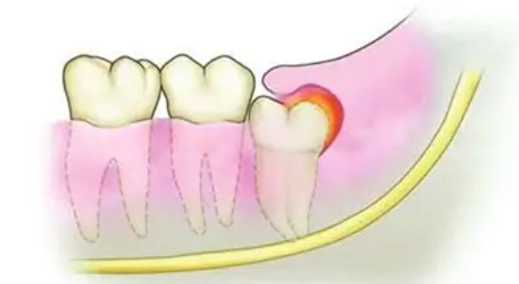 智齒發炎怎麼辦