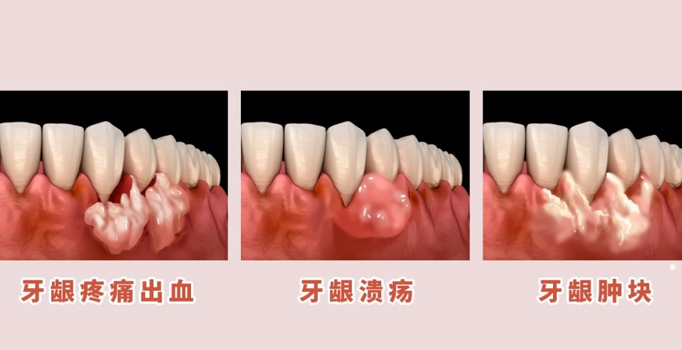 智齒發炎怎麼辦