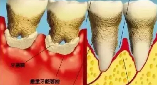 牙齦萎縮怎麼辦