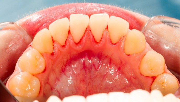 牙齦萎縮怎麼辦