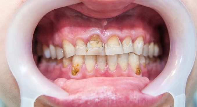 牙齦腫痛怎麼辦