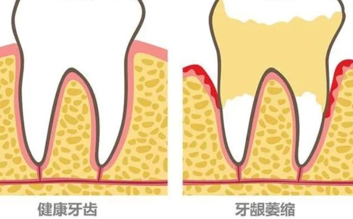 牙齦萎縮原因