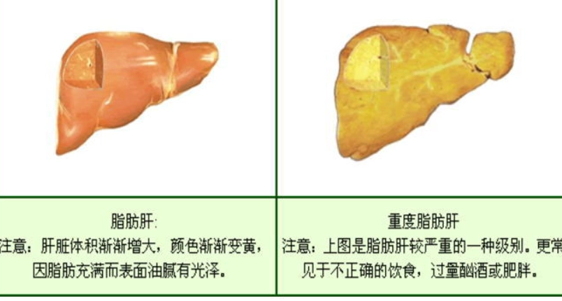 重度脂肪肝