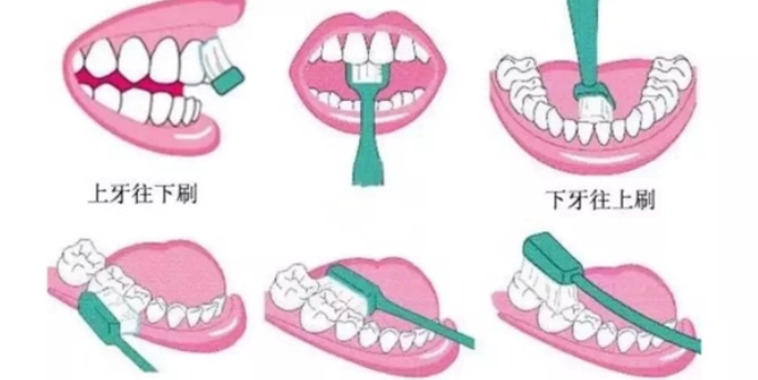 琺瑯質修復 琺瑯質修復