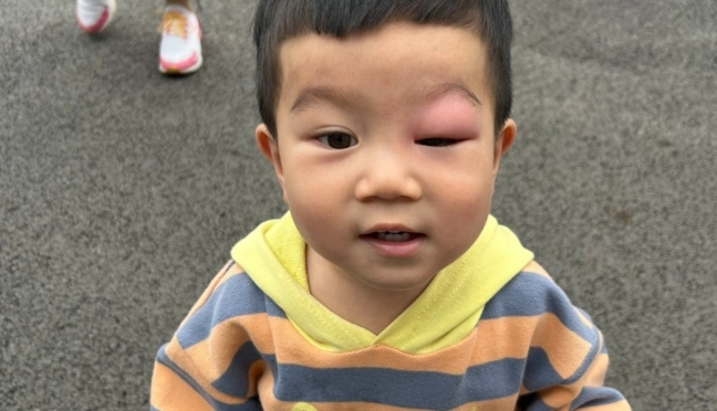 眼皮蚊子叮消腫方法